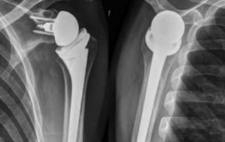 Postoperatives Röntgenbild