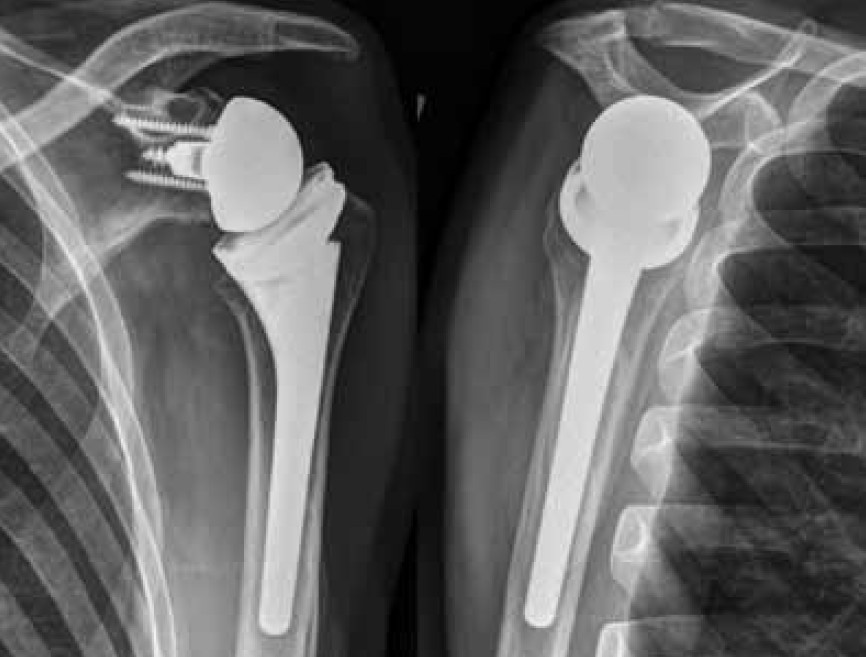 Postoperatives Röntgenbild