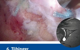 Tübinger Arthroskopie Symposium Schulter 2017