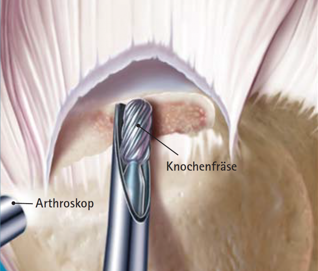 Abb 04 Fräsen einer Knochennut zur besseren Einheilung der refixierten Sehne