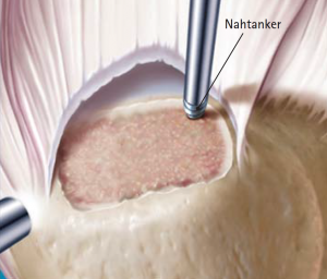 Abb 06 Eindrehen des Nahtankers in die Knochennut
