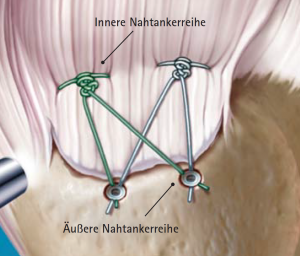 Abb 08 Refixierte Sehne mit einer inneren und äußeren Nahtankerreihe