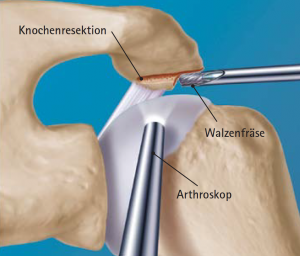 Abb 09 Arthroskopische Akromioplastik