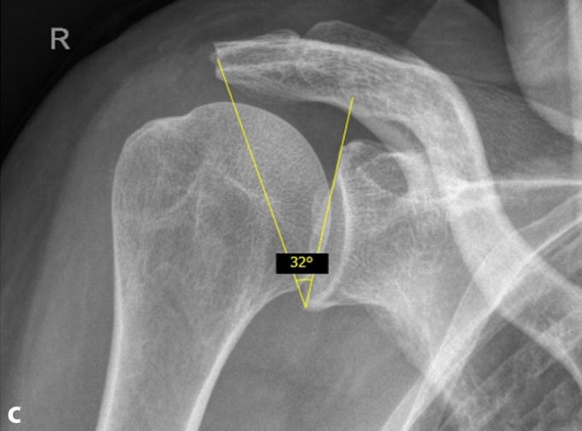 Lateral acromioplasty for correction of the critical shoulder angle Deutsches Schulterzentrum